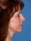 Nose Surgery Picture
