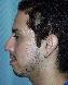 Nose Surgery Picture