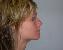 Nose Surgery Picture