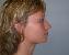 Nose Surgery Picture